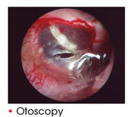 Otoscopy