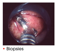 Biopsies