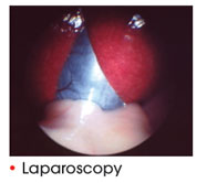 Laparoscopy