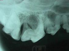 Xray of teeth